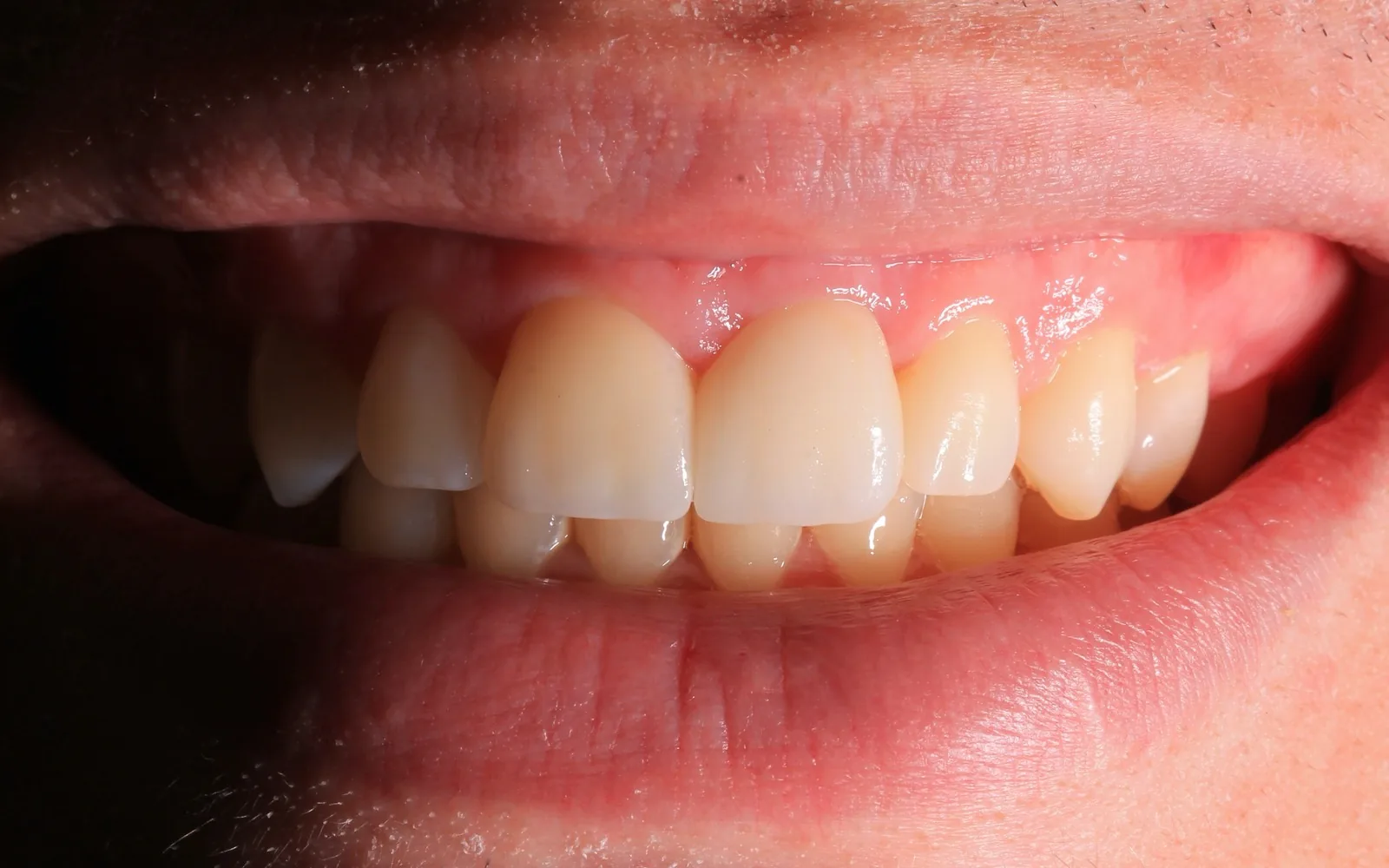 Sorriso do paciente depois do tratamento