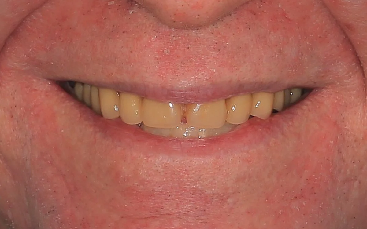 Sorriso do paciente antes do tratamento