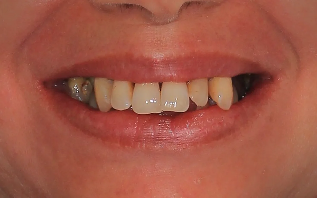Sorriso do paciente antes do tratamento