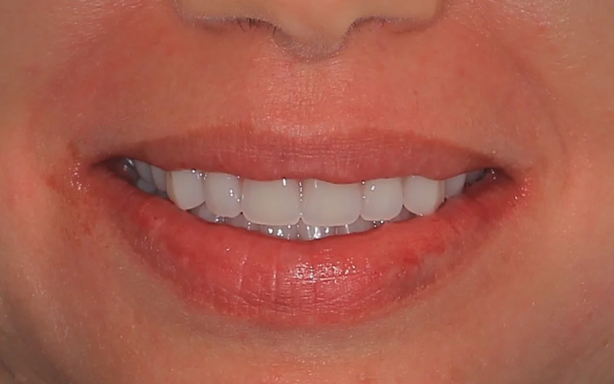 Sorriso do paciente depois do tratamento